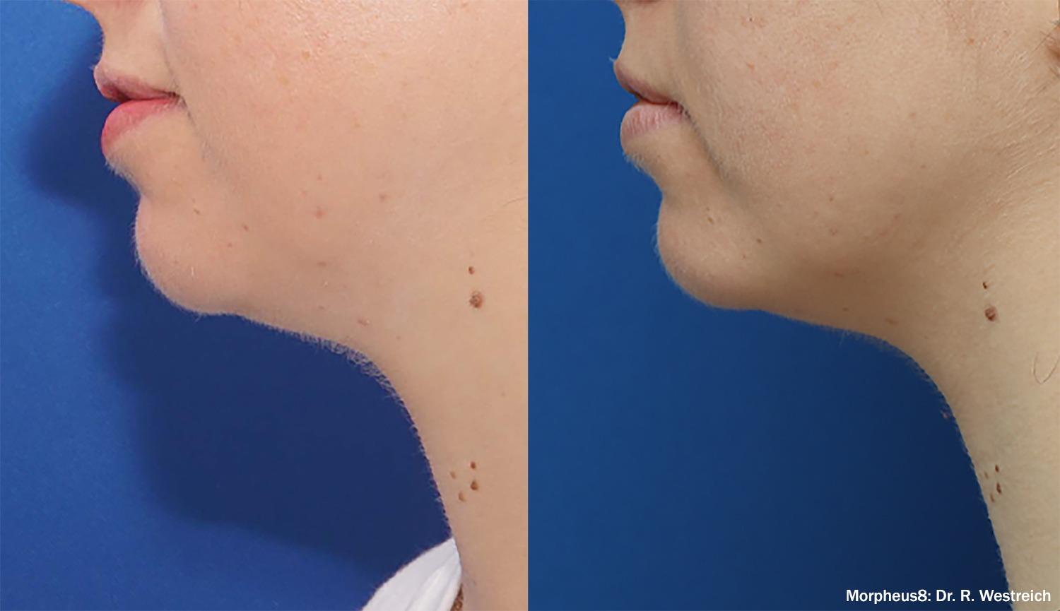 Chernoff Cosmetic Surgery skin tightening result — Indianapolis, IN