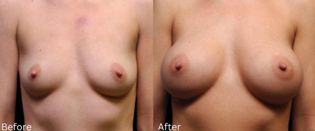Breast Augmentation result at Chernoff Cosmetic Surgery in Indianapolis, IN