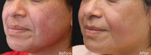 Laser Skin Resurfacing result at Chernoff Cosmetic Surgery in Indianapolis, IN