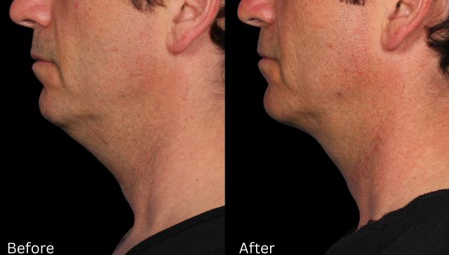 Neck Lift result at Chernoff Cosmetic Surgery in Indianapolis, IN