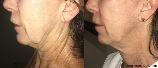 Morpheus8 result at Chernoff Cosmetic Surgery in Indianapolis, IN