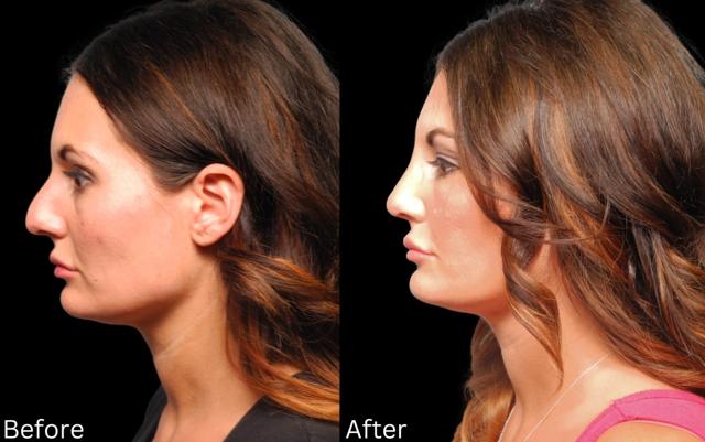 Rhinoplasty result at Chernoff Cosmetic Surgery in Indianapolis, IN