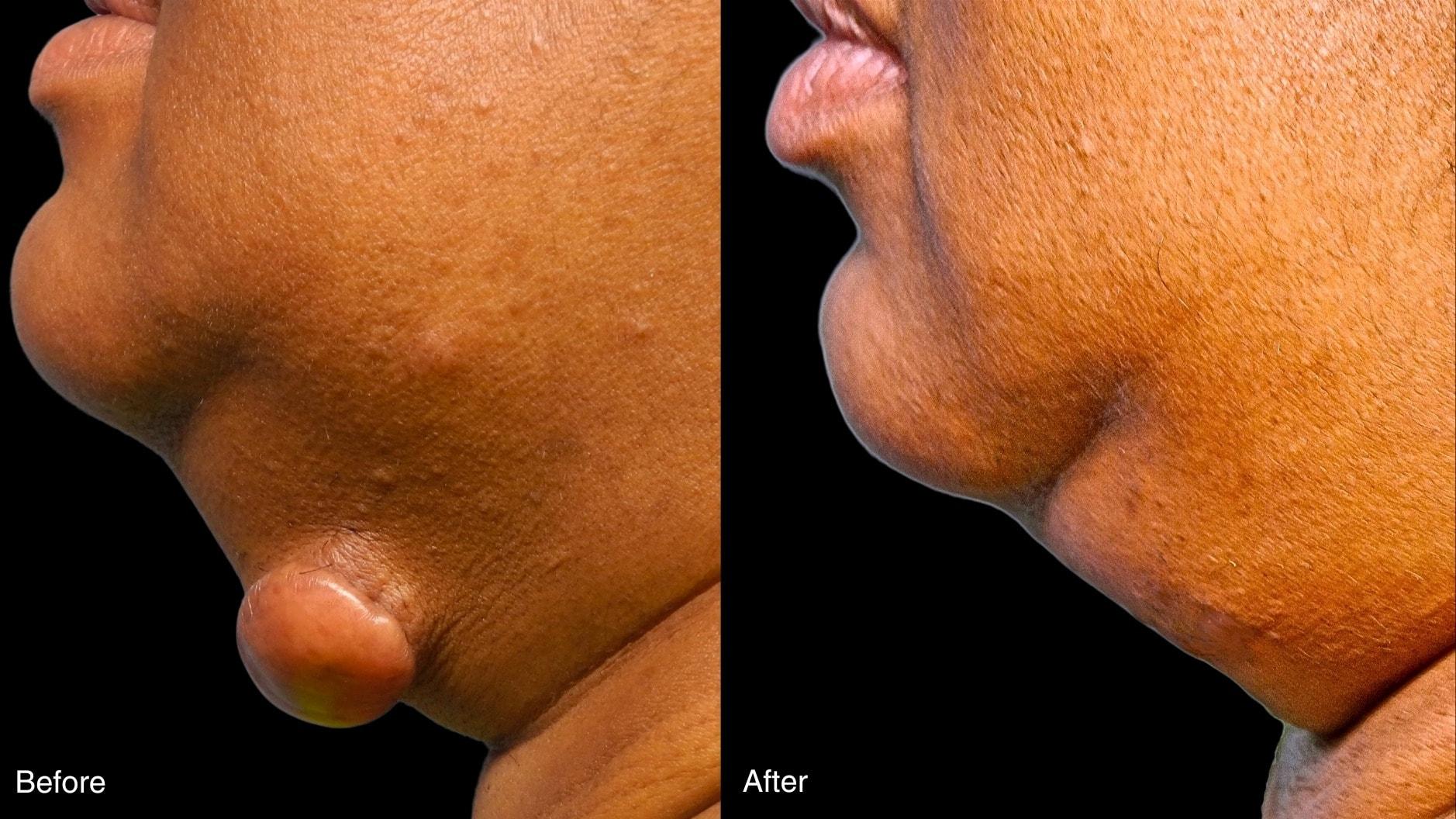 Chernoff Cosmetic Surgery scar treatment result — Indianapolis, IN