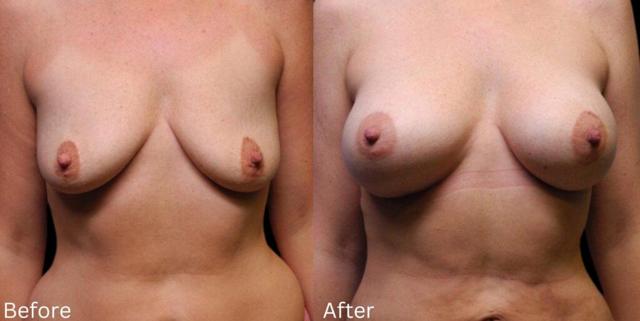 Breast Augmentation result at Chernoff Cosmetic Surgery in Indianapolis, IN