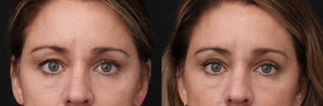 Blepharoplasty result at Chernoff Cosmetic Surgery in Indianapolis, IN