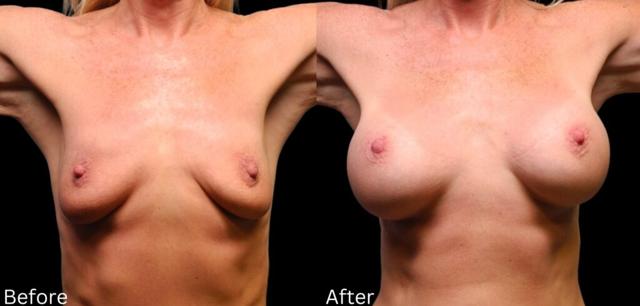 Breast Augmentation result at Chernoff Cosmetic Surgery in Indianapolis, IN