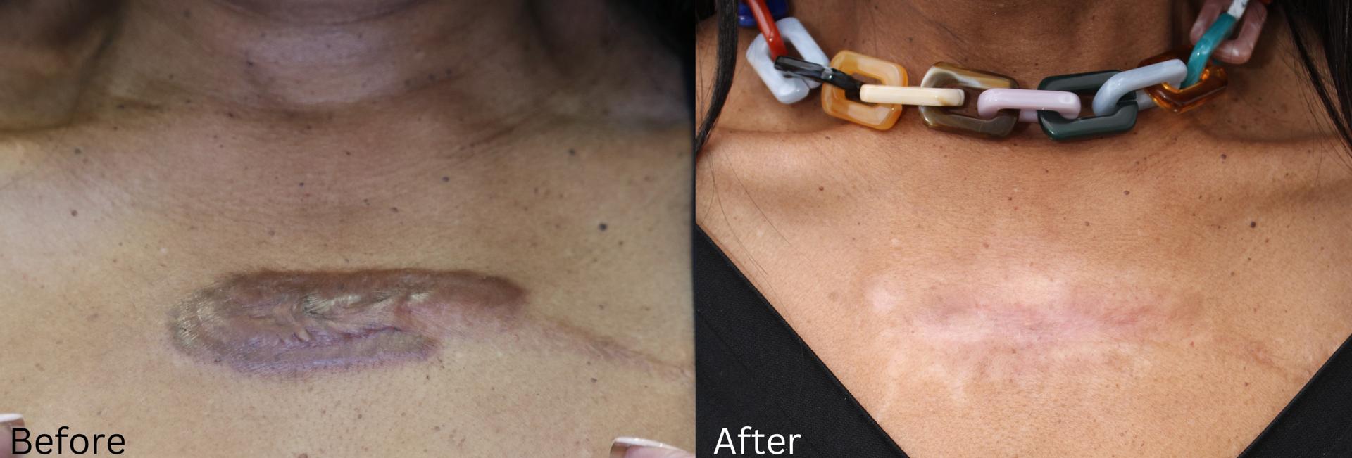 Chernoff Cosmetic Surgery scar treatment result — Indianapolis, IN
