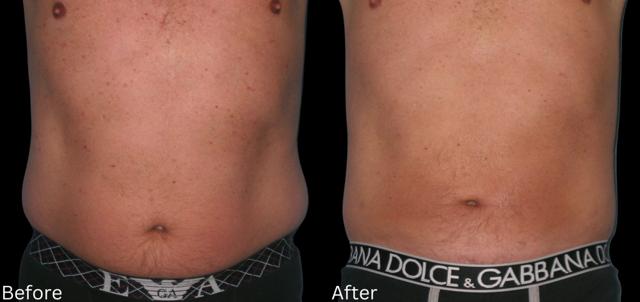 Liquid BBL result at Chernoff Cosmetic Surgery in Indianapolis, IN