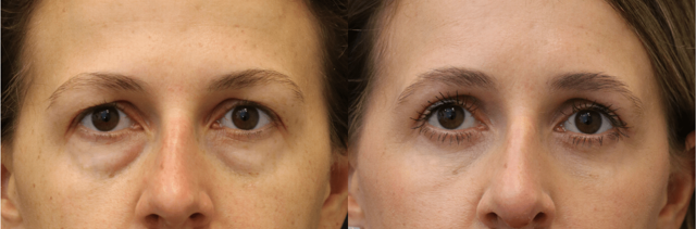 Blepharoplasty result at Chernoff Cosmetic Surgery in Indianapolis, IN