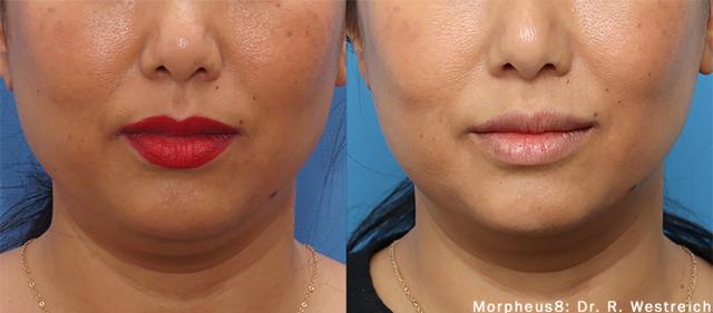 Morpheus8 result at Chernoff Cosmetic Surgery in Indianapolis, IN