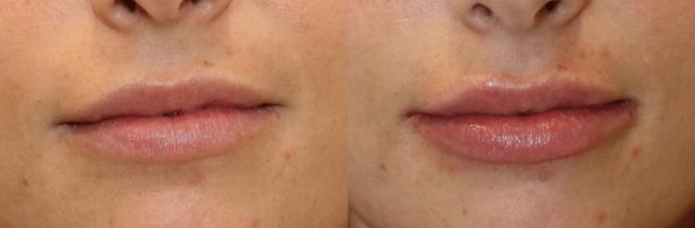 Lip Filler result at Chernoff Cosmetic Surgery in Indianapolis, IN