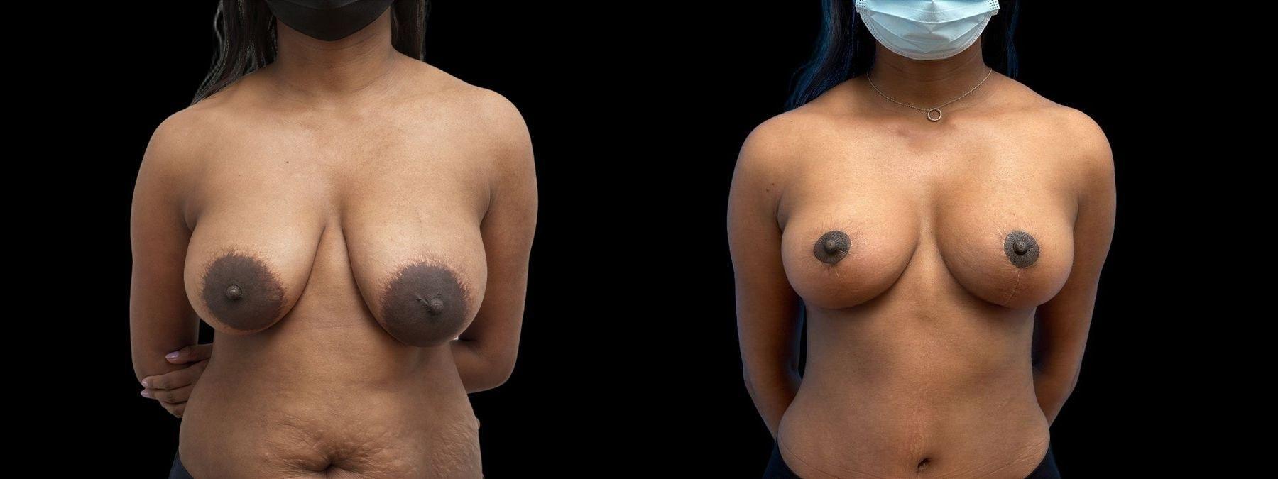 David J. Levens, MD Plastic Surgery breast lift result — Coral Springs, FL