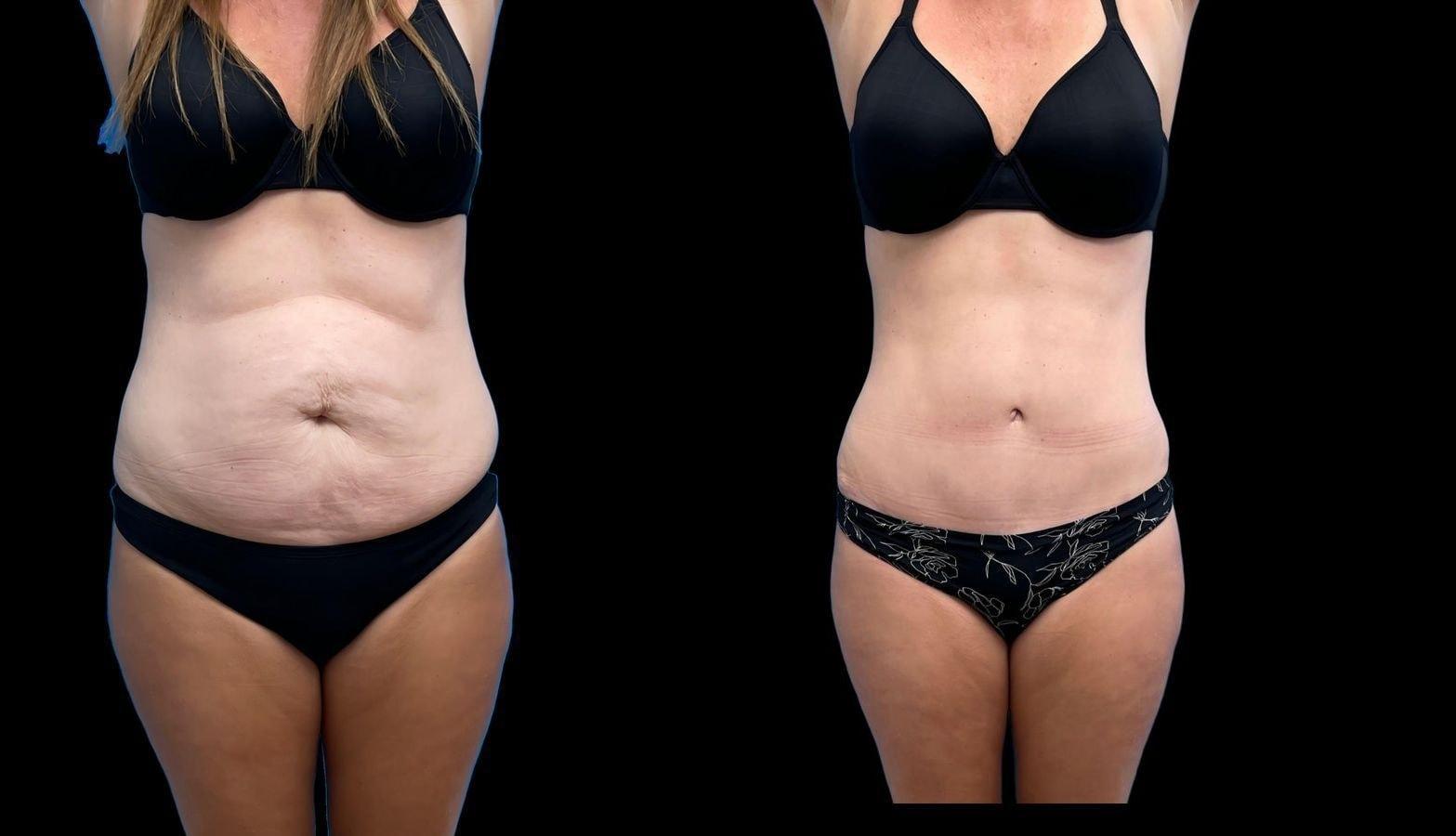 David J. Levens, MD Plastic Surgery tummy tuck result — Coral Springs, FL