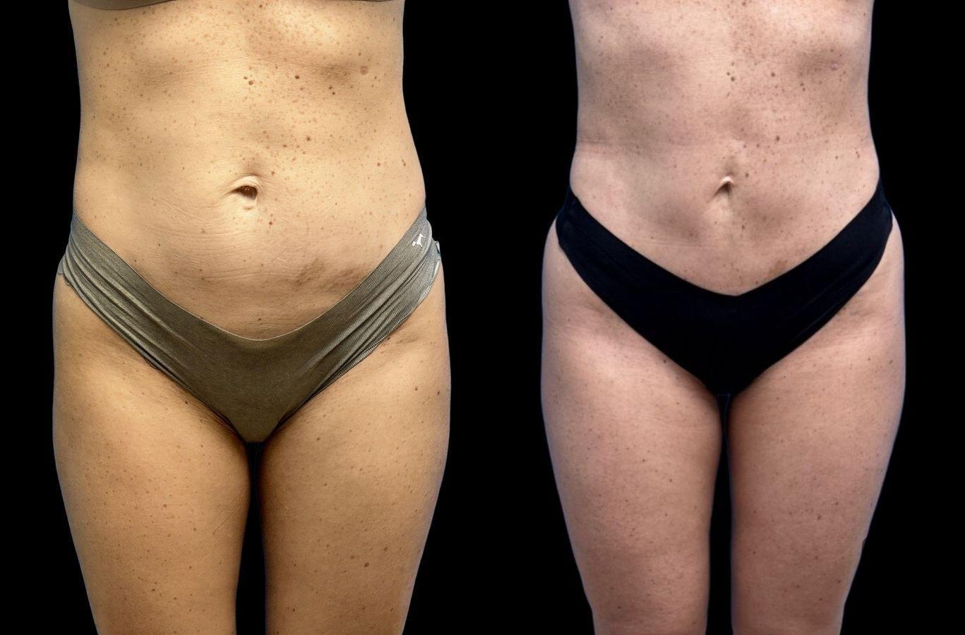 David J. Levens, MD Plastic Surgery tummy tuck result — Coral Springs, FL