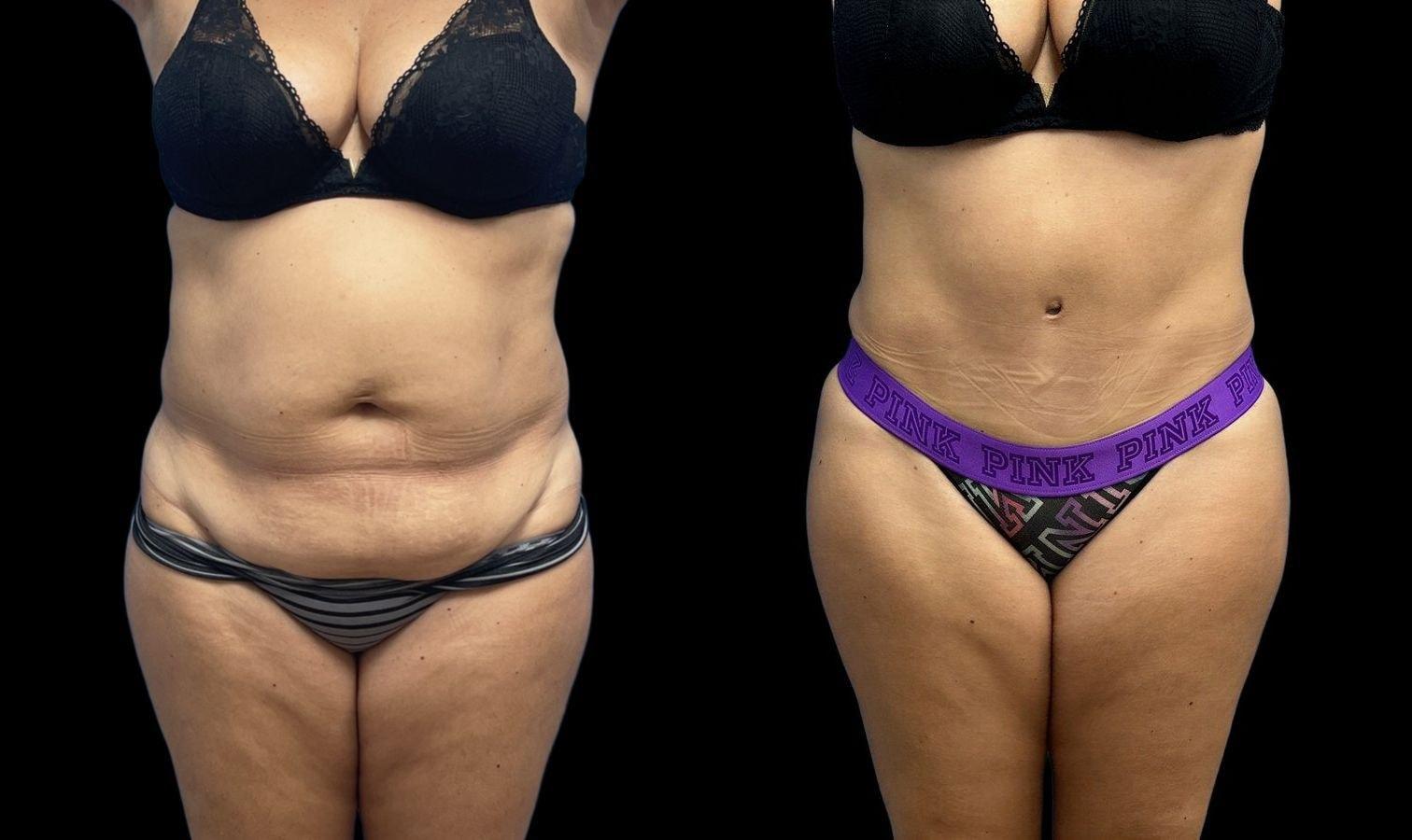 David J. Levens, MD Plastic Surgery tummy tuck result — Coral Springs, FL