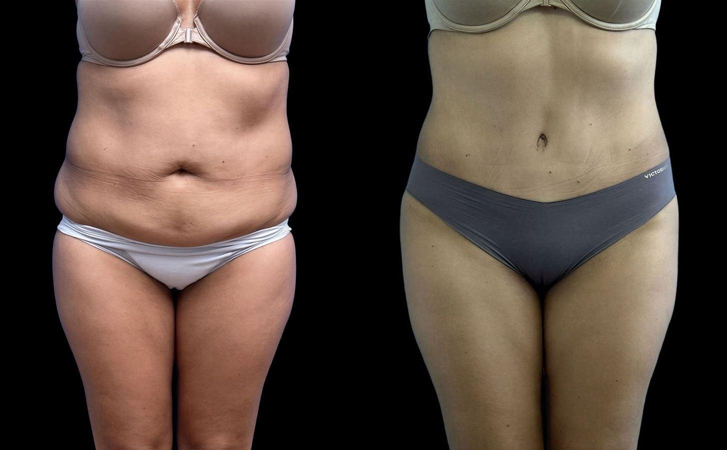 David J. Levens, MD Plastic Surgery tummy tuck result — Coral Springs, FL