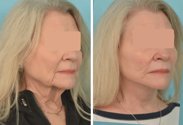 Facelift result at Mobley MD Facial Plastic Surgery in Millcreek, UT