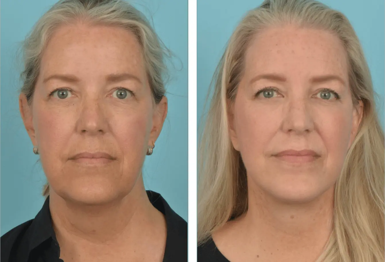 Mobley MD Facial Plastic Surgery facelift result — Millcreek, UT
