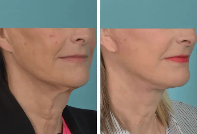 Facelift result at Mobley MD Facial Plastic Surgery in Millcreek, UT