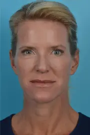 Mobley MD Facial Plastic Surgery facelift result — Millcreek, UT