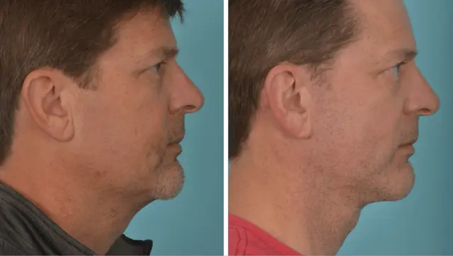 Facelift result at Mobley MD Facial Plastic Surgery in Millcreek, UT