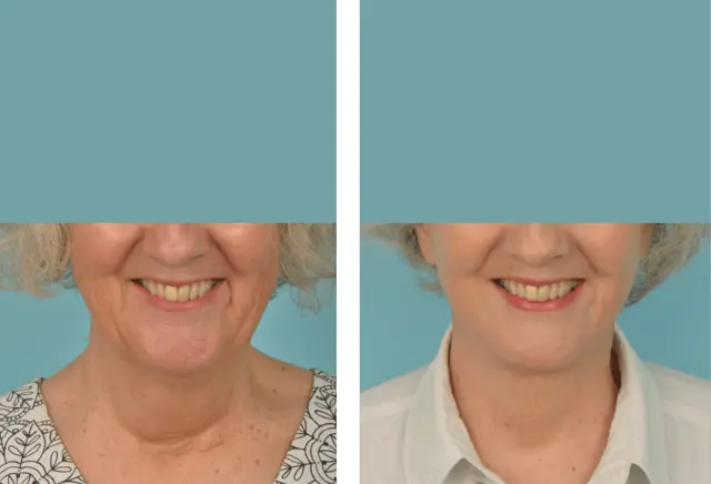 Facelift result at Mobley MD Facial Plastic Surgery in Millcreek, UT