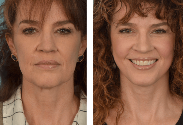 Facelift result at Mobley MD Facial Plastic Surgery in Millcreek, UT