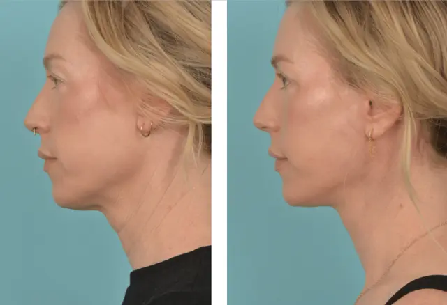 Facelift result at Mobley MD Facial Plastic Surgery in Millcreek, UT