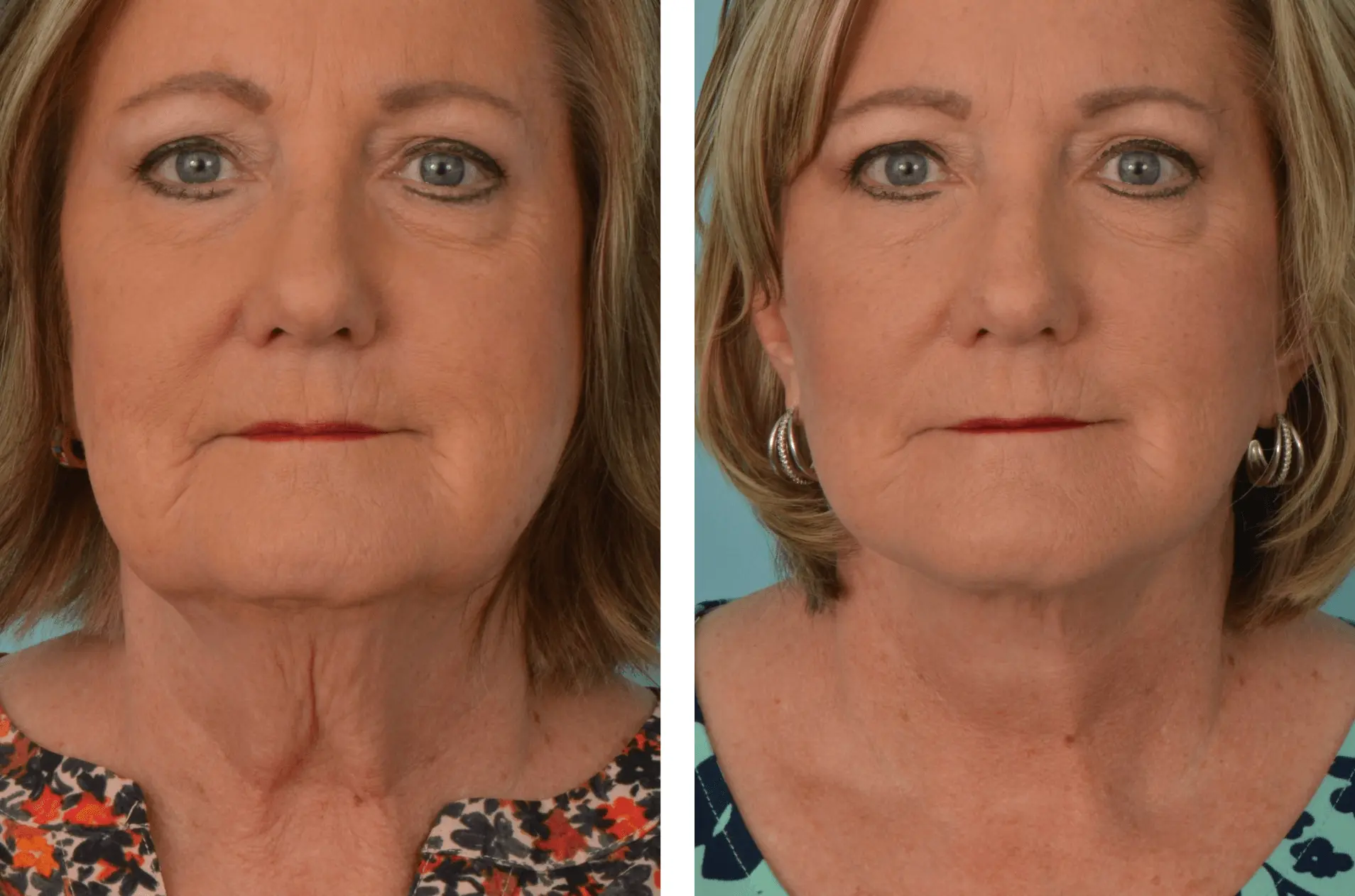 Mobley MD Facial Plastic Surgery facelift result — Millcreek, UT