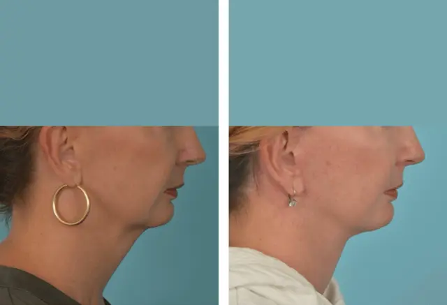 Neck Lift result at Mobley MD Facial Plastic Surgery in Millcreek, UT