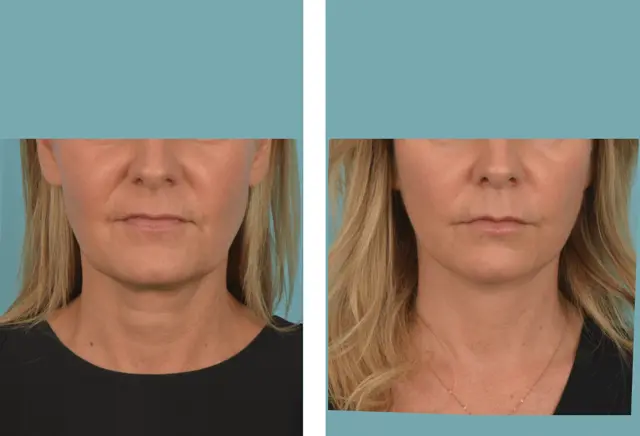 Facelift result at Mobley MD Facial Plastic Surgery in Millcreek, UT