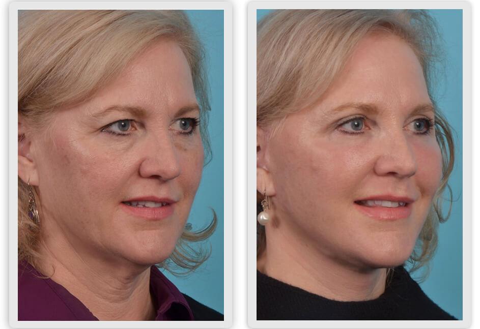 Mobley MD Facial Plastic Surgery result — Millcreek, UT