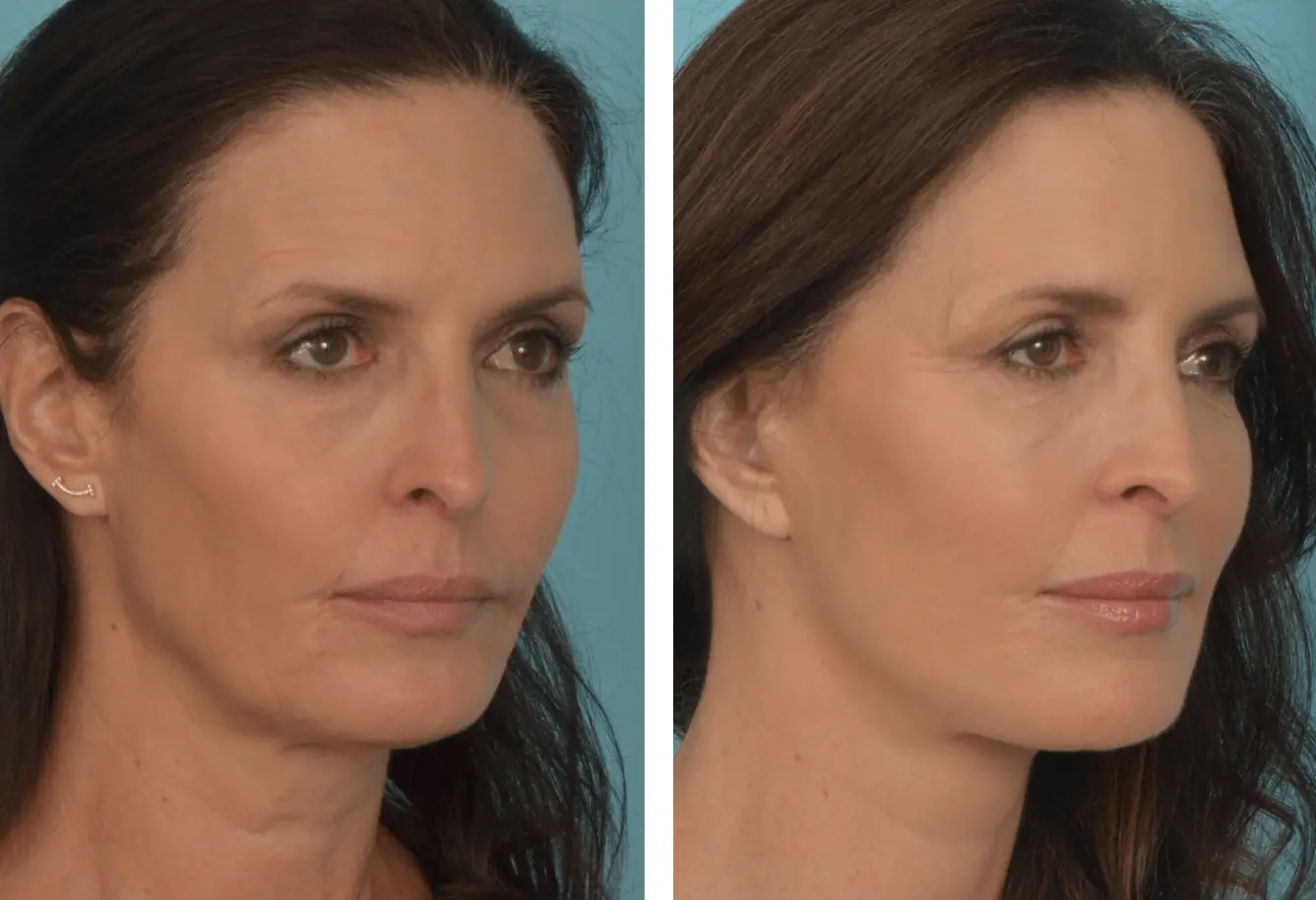 Mobley MD Facial Plastic Surgery result — Millcreek, UT