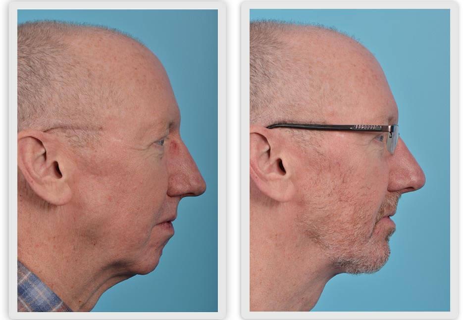 Mobley MD Facial Plastic Surgery result — Millcreek, UT