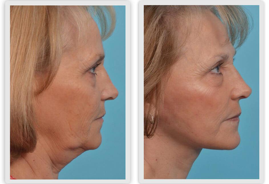 Mobley MD Facial Plastic Surgery result — Millcreek, UT