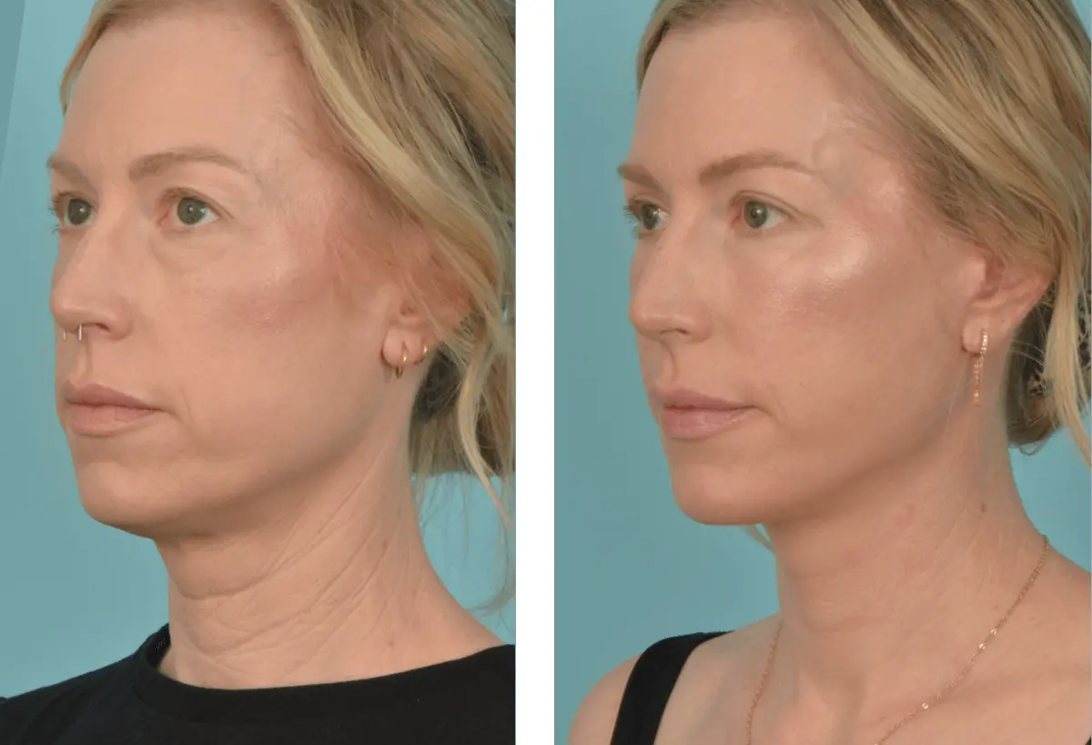Mobley MD Facial Plastic Surgery facelift result — Millcreek, UT