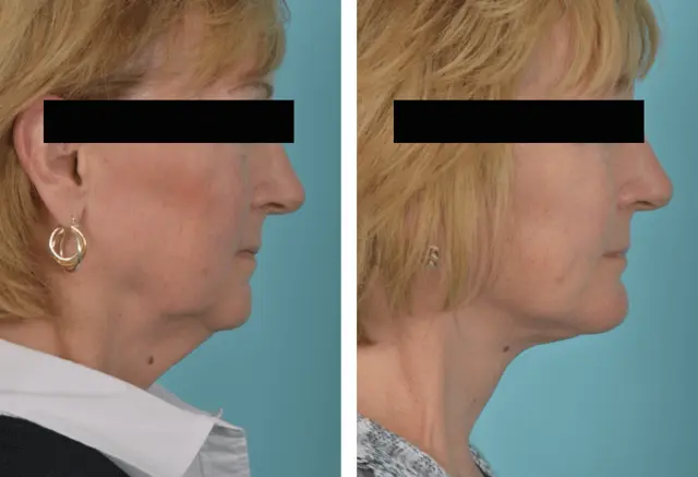 Facelift result at Mobley MD Facial Plastic Surgery in Millcreek, UT