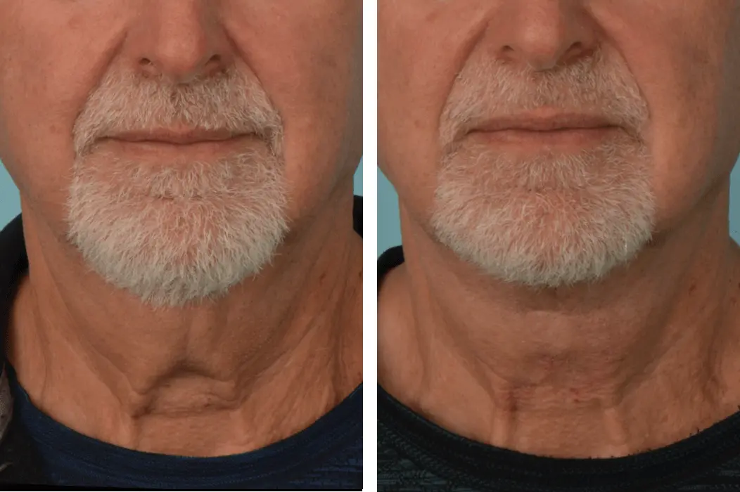 Mobley MD Facial Plastic Surgery result — Millcreek, UT