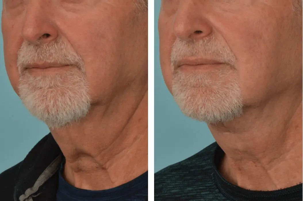 Mobley MD Facial Plastic Surgery result — Millcreek, UT