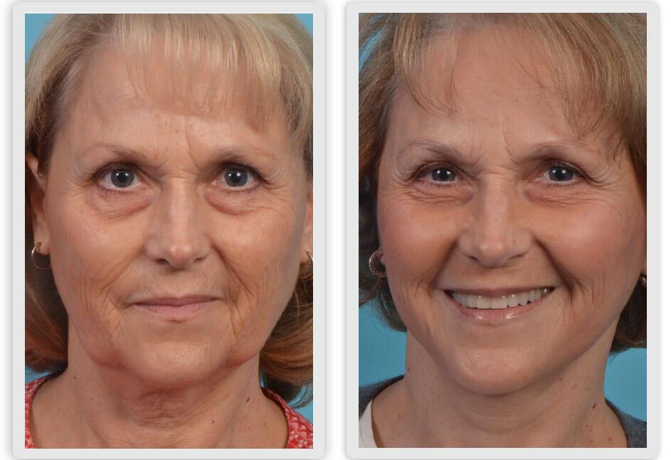 Mobley MD Facial Plastic Surgery result — Millcreek, UT