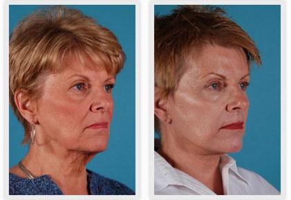 Mobley MD Facial Plastic Surgery result — Millcreek, UT