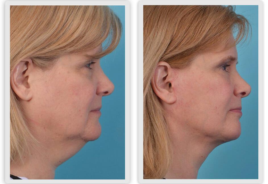 Mobley MD Facial Plastic Surgery result — Millcreek, UT