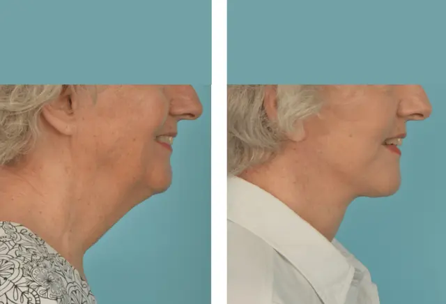 Facelift result at Mobley MD Facial Plastic Surgery in Millcreek, UT