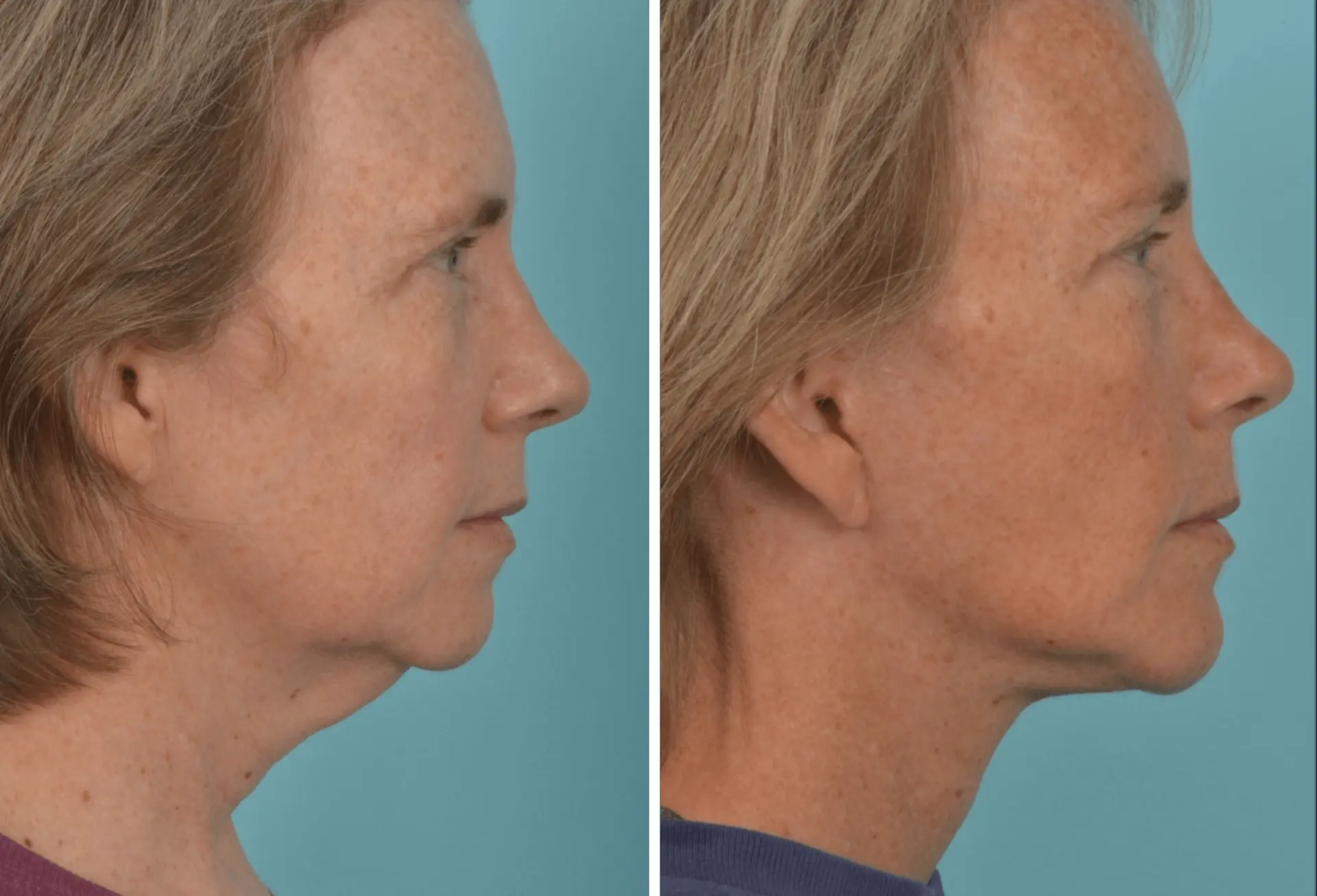 Mobley MD Facial Plastic Surgery facelift result — Millcreek, UT