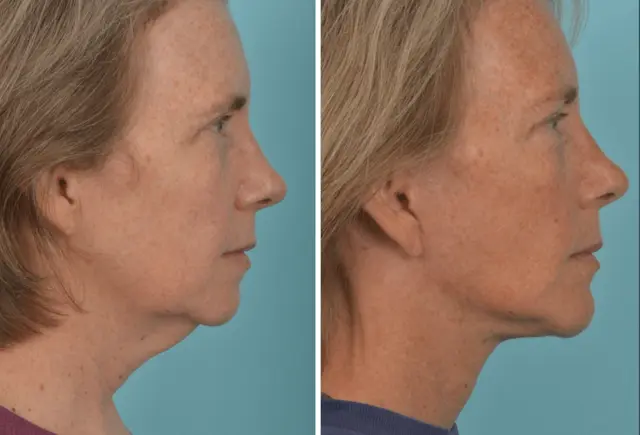 Facelift result at Mobley MD Facial Plastic Surgery in Millcreek, UT