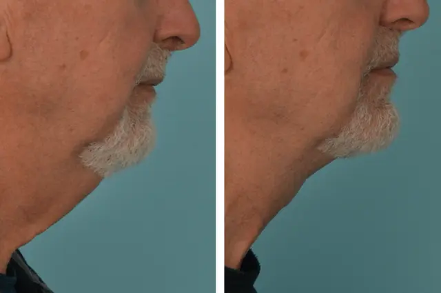 Neck Lift result at Mobley MD Facial Plastic Surgery in Millcreek, UT