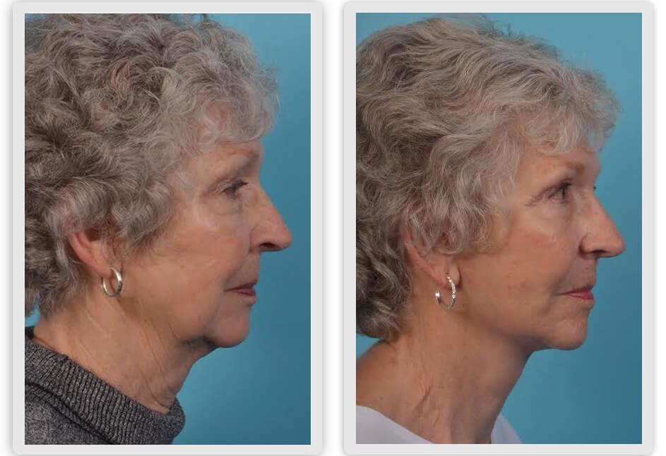 Mobley MD Facial Plastic Surgery result — Millcreek, UT