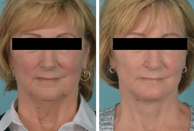 Facelift result at Mobley MD Facial Plastic Surgery in Millcreek, UT