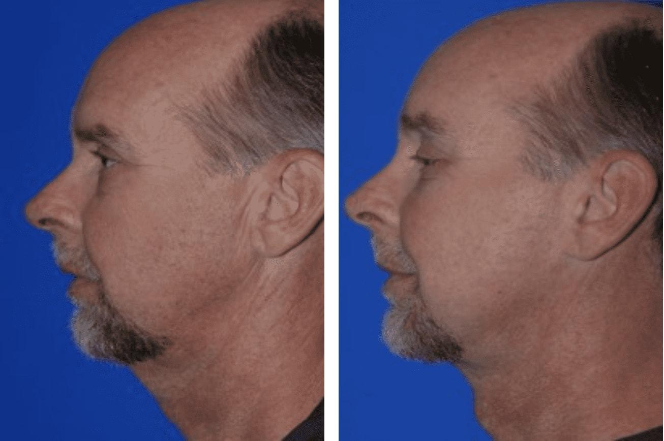 Pasadena Plastic Surgery (Michael Schwartz, MD) neck lift result — Pasadena, CA