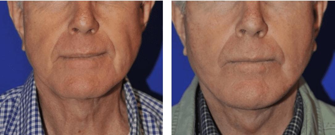 Pasadena Plastic Surgery (Michael Schwartz, MD) neck lift result — Pasadena, CA